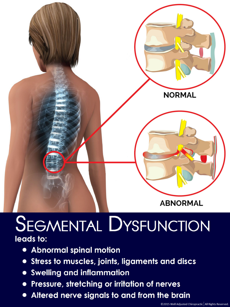 Corrective Chiropractic Segmental Dysfunction